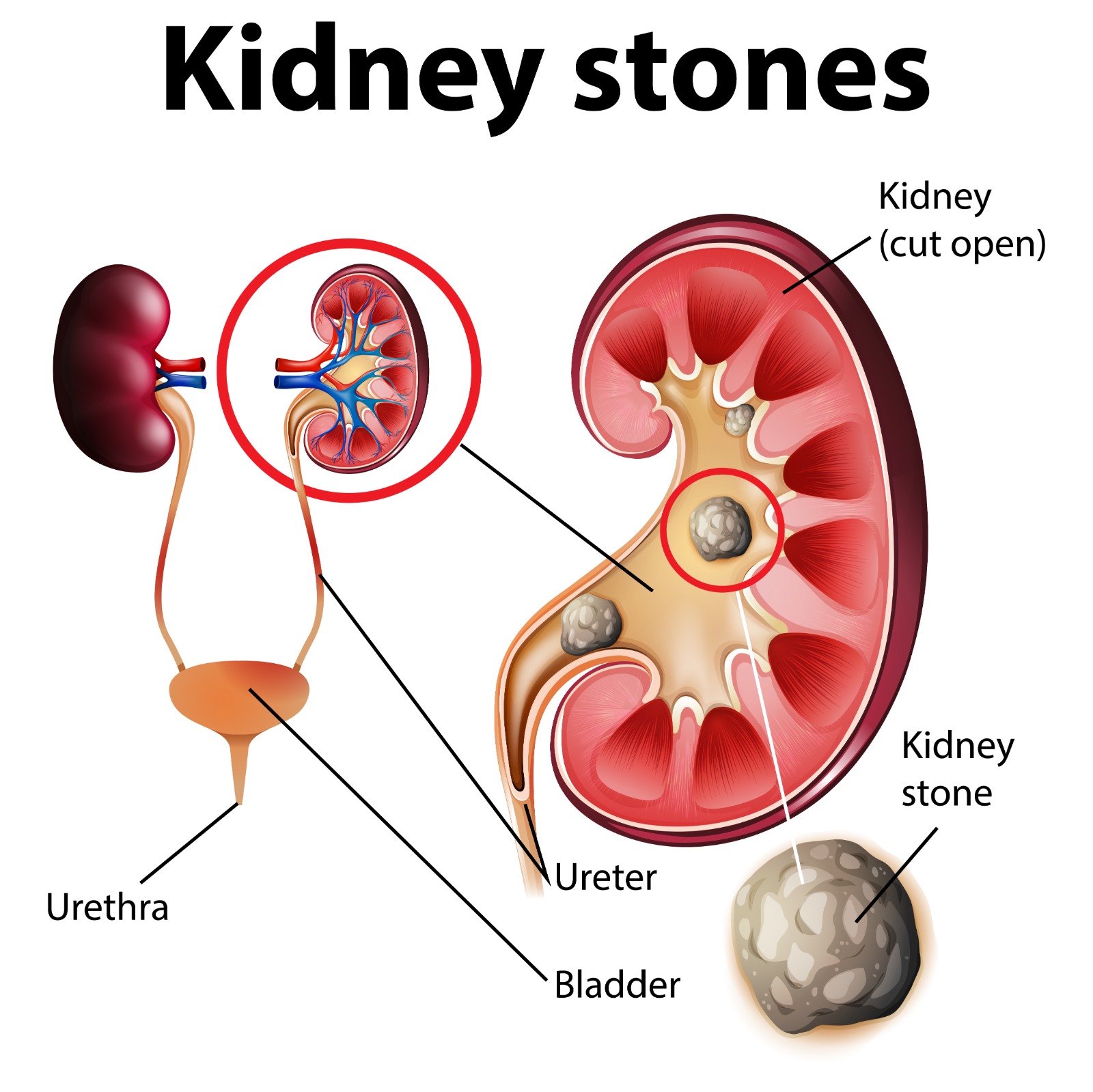 Kidney Stone Treatment